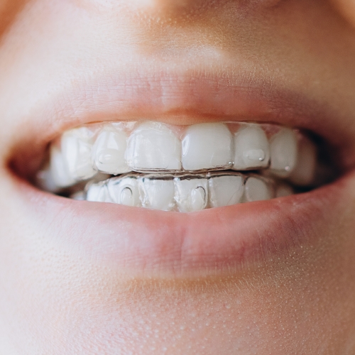 Tandretning med invisalign